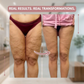 LightLegs™ Compression Leggings for Lipoedema & Swelling Relief