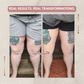 LightLegs™ Compression Leggings for Lipoedema & Swelling Relief